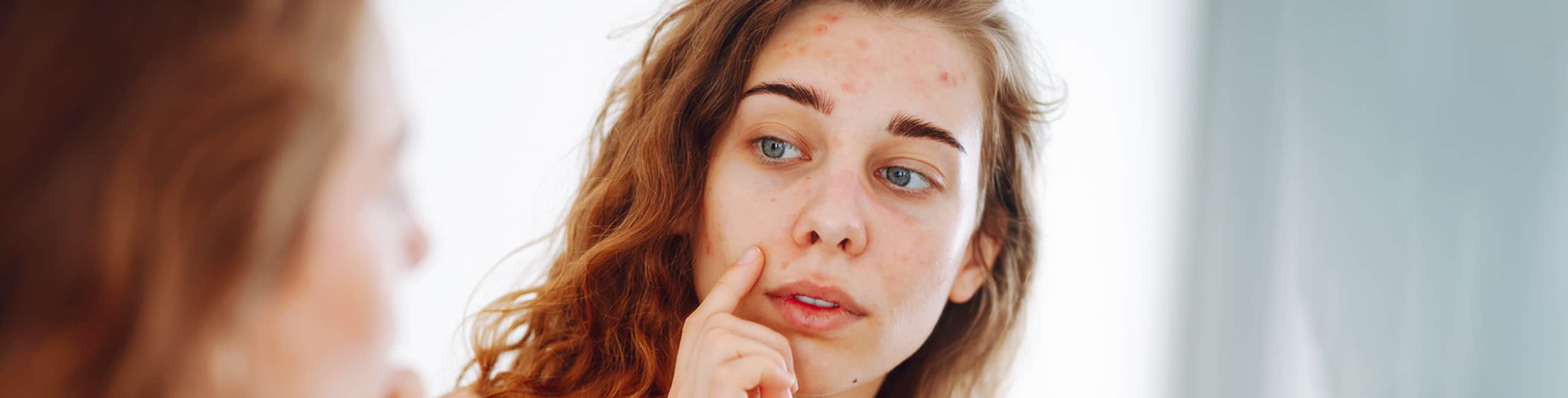 Junge Frau mit PCOS betrachtet ihr zu Akne neigendes Gesicht im Spiegel – Catafertyl