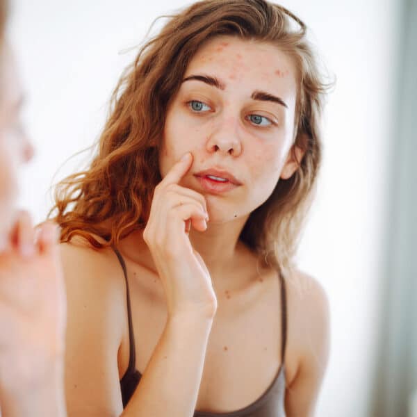 Junge Frau mit PCOS betrachtet ihr zu Akne neigendes Gesicht im Spiegel – Catafertyl