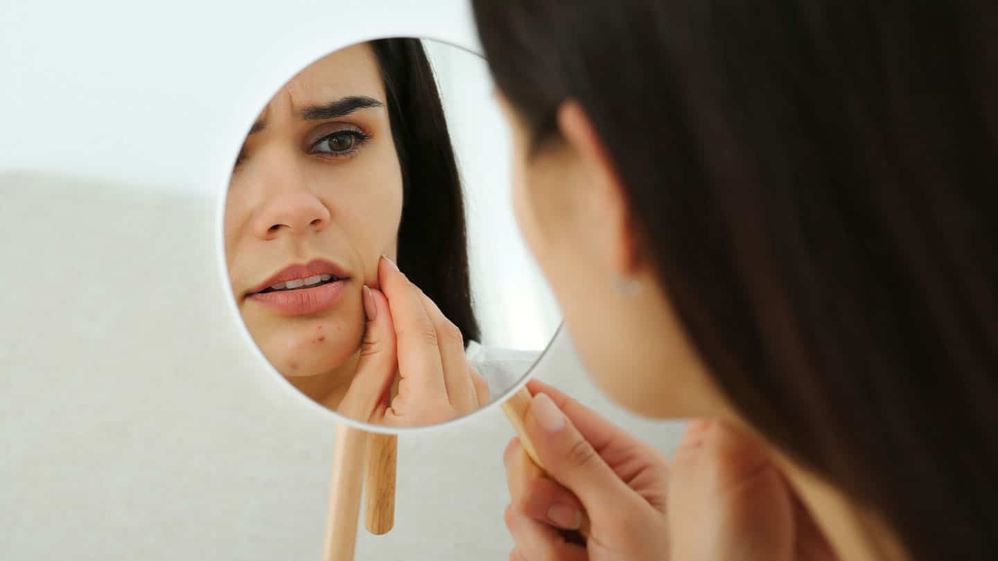 Akne im Spiegel