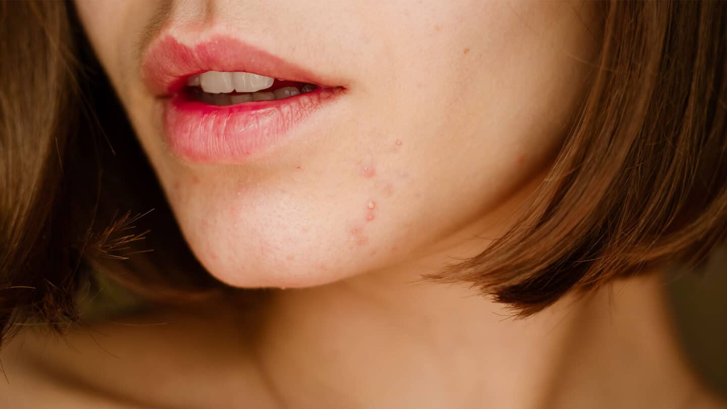 Frau mit PCOS und Gesichtsakne – Catafertyl